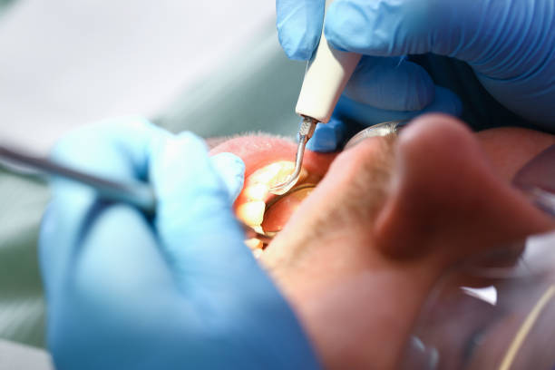 Best Emergency Wisdom Tooth Extraction in Boonton, NJ