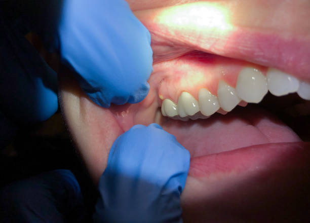 Best Broken or Chipped Tooth Repair in Boonton, NJ